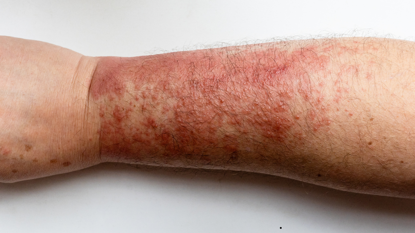 Skin Diseases